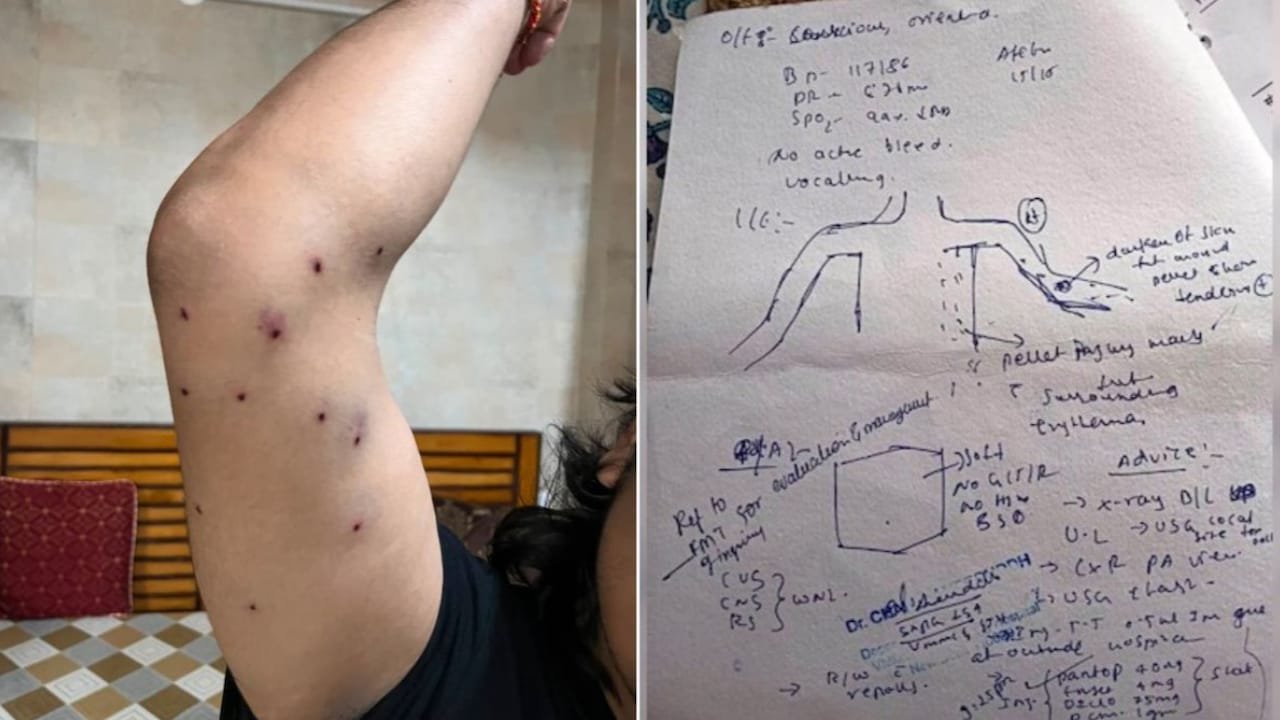 "Pellet Shards Stuck To Skin": Hospital Report Contradicts Delhi Police Claim