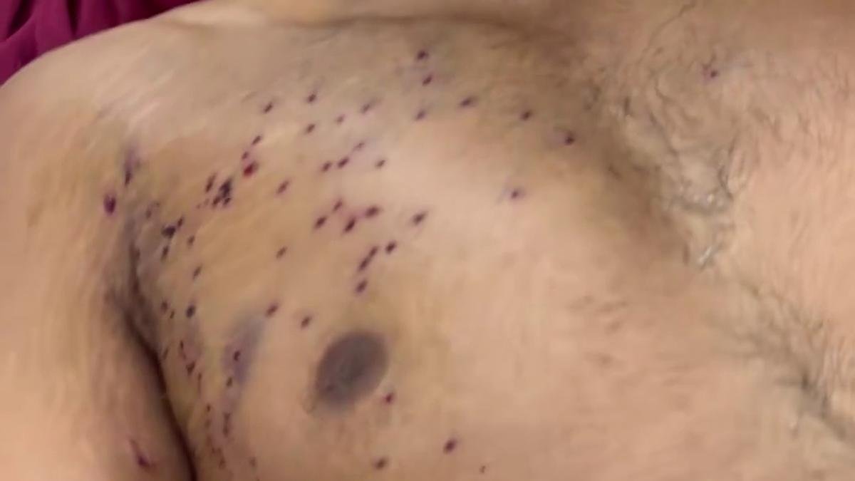 19-year-old may lose vision in right eye due to pellet injury, says family