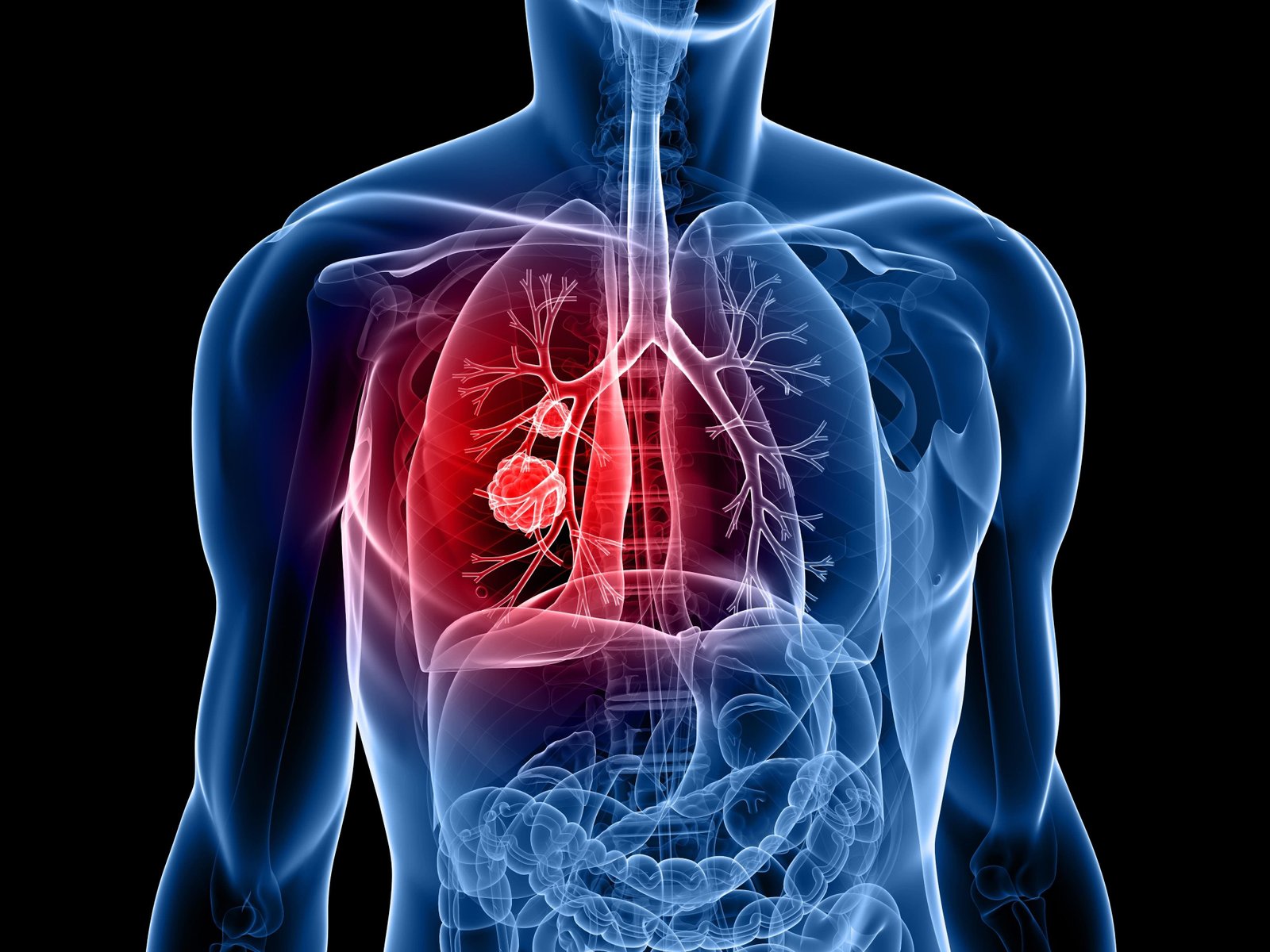 Breakthrough Pancreatic Cancer Drug Shows Promise In Lung Cancer Trial