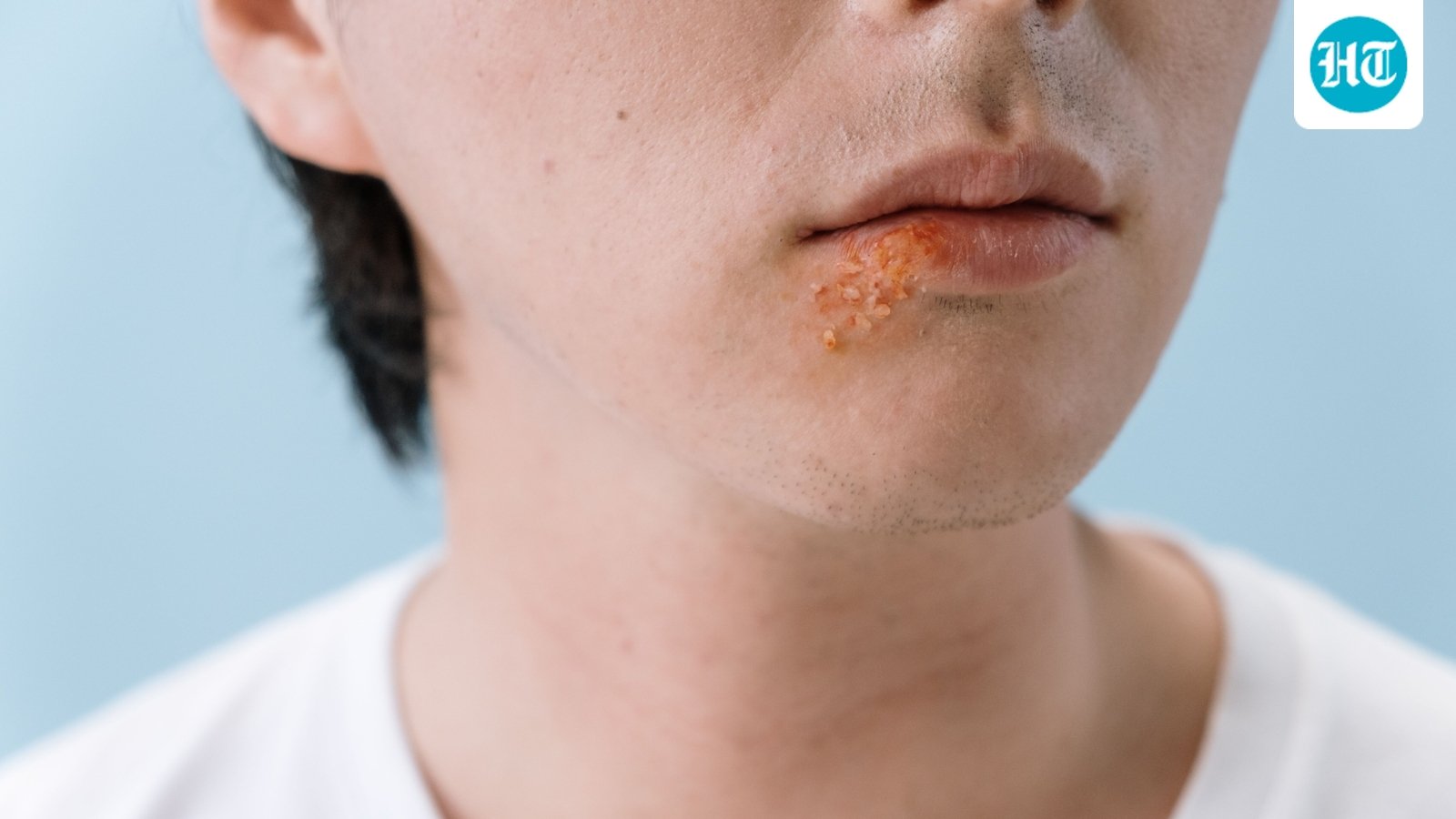 Think lip balm is 'not for him'? Dermatologist shares 4 lip care tips every man should know