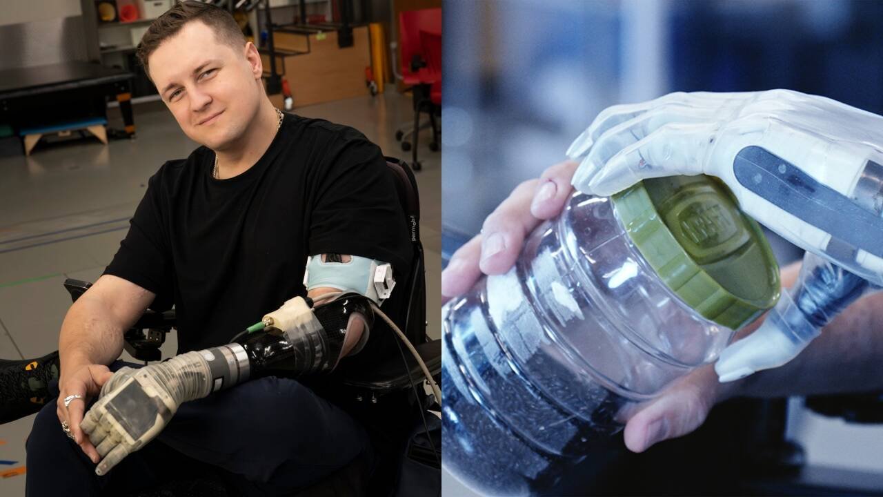 17 years after losing his arm, he can feel again with a bionic limb
